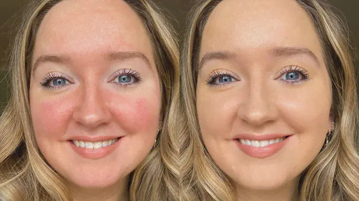 Rosacea, redness and sensitive skincare picks